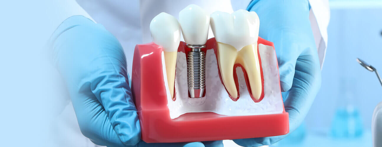 Dental Implants in Sugar Land, TX Dental Implants Near You