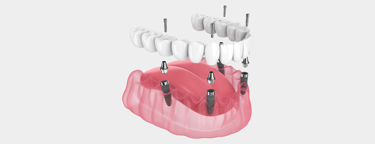 All-on-4® Dental Implants in Richmond, TX, All-on-4® Dental Implants Near me