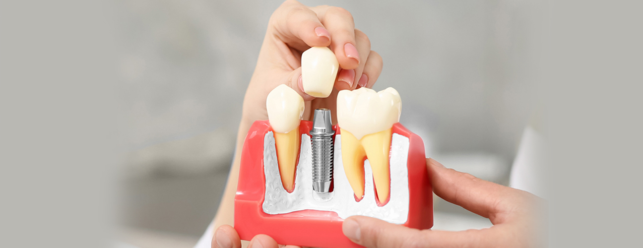 Dental Implants in Richmond, TX, Dental Implants Near me