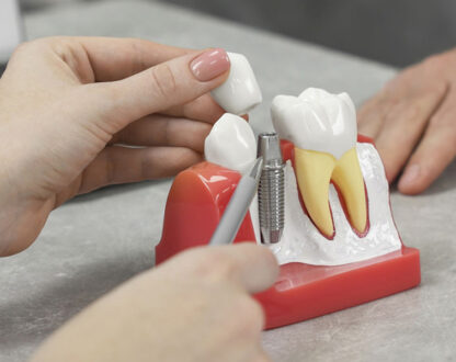 Enhance Your Smile with Precision: Dental Implants at Elegant Dental Sugar Land