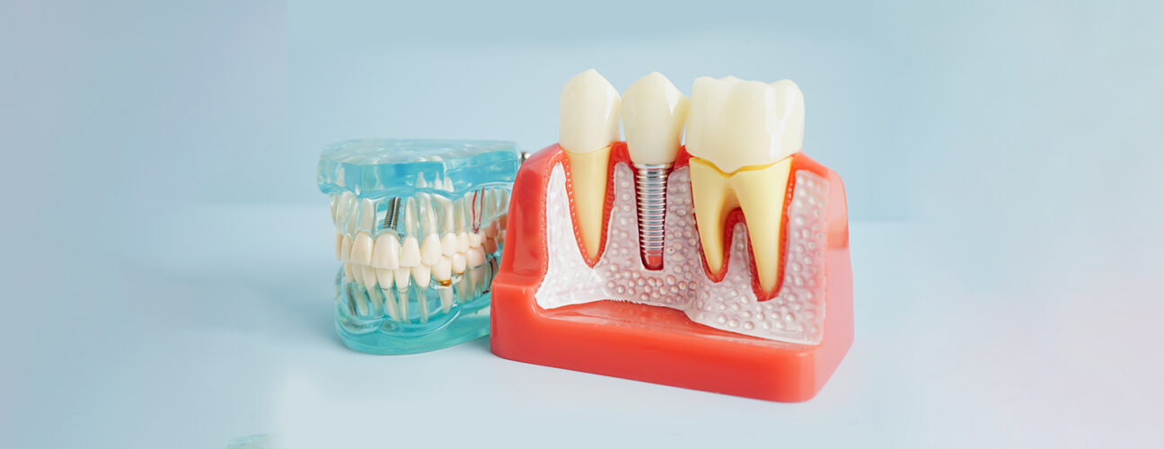 dental implants richmond tx , dental office near you, dentist near you