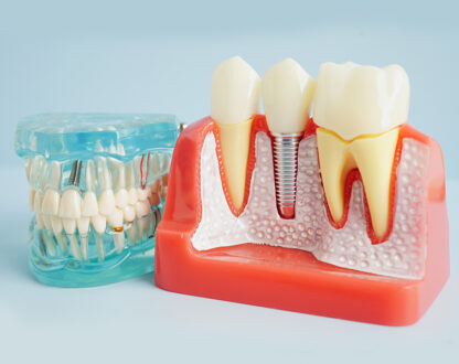 dental implants richmond tx , dental office near you, dentist near you