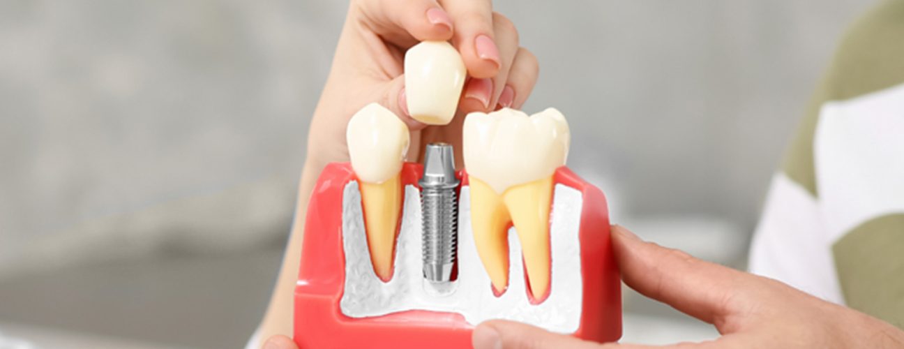 dental implants in Sugar Land, TX, dental implants near me, dentist in sugar land