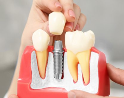 dental implants in Sugar Land, TX, dental implants near me, dentist in sugar land