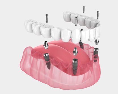 All-on-4 Dental Implants in Richmond TX, Dental Implants near you, dentist 77406,