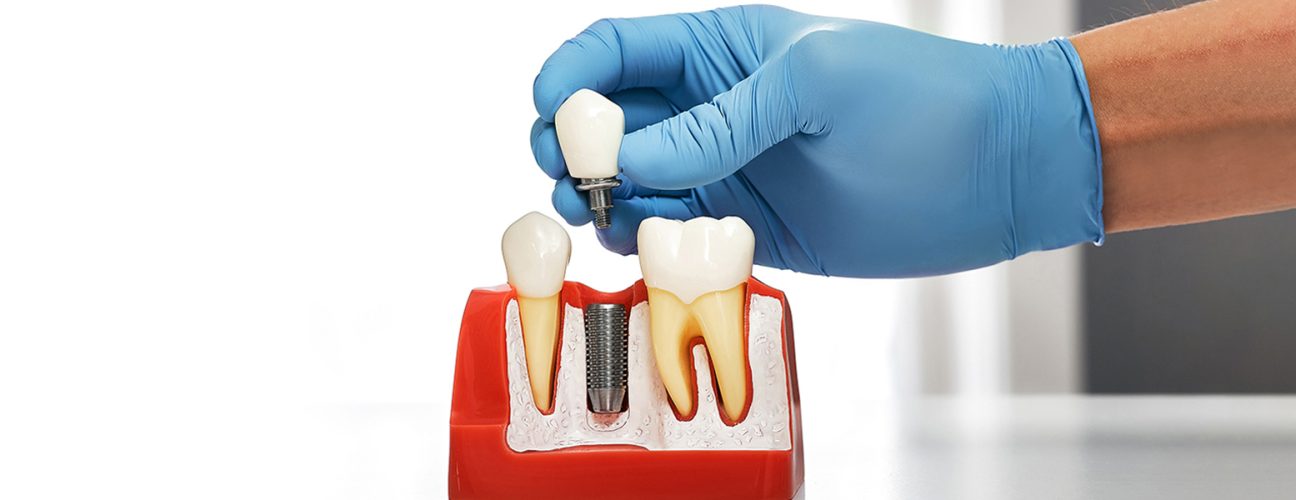 Are Dental Implants Right for You? A Sugar Land Dentist Answers