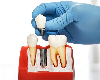 Are Dental Implants Right for You? A Sugar Land Dentist Answers