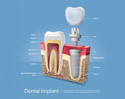 Dental Implants in Richmond, TX, Dental Implants near me