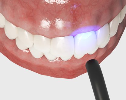 Dental Bonding in Richmond, TX, Dental Bonding near you