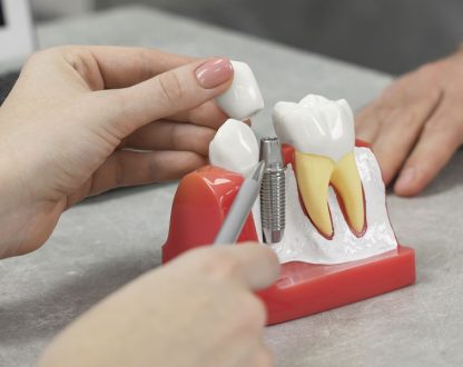 What Patients Should Know About Choosing a Dental Implant Specialist in Richmond