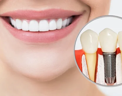 dental implants in Sugar Land, TX, dental implants near me